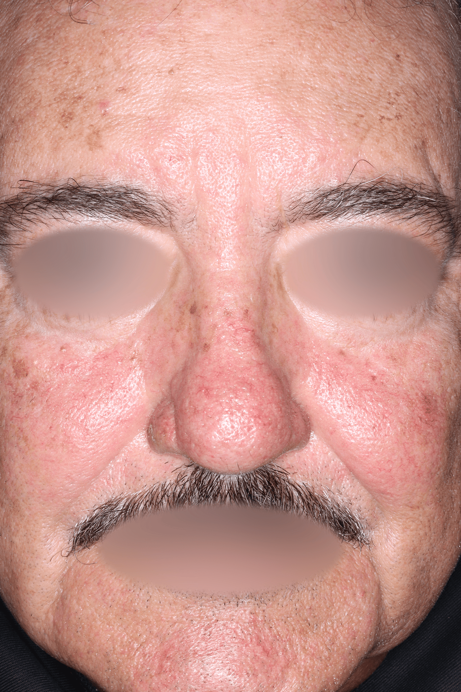 Patient A After