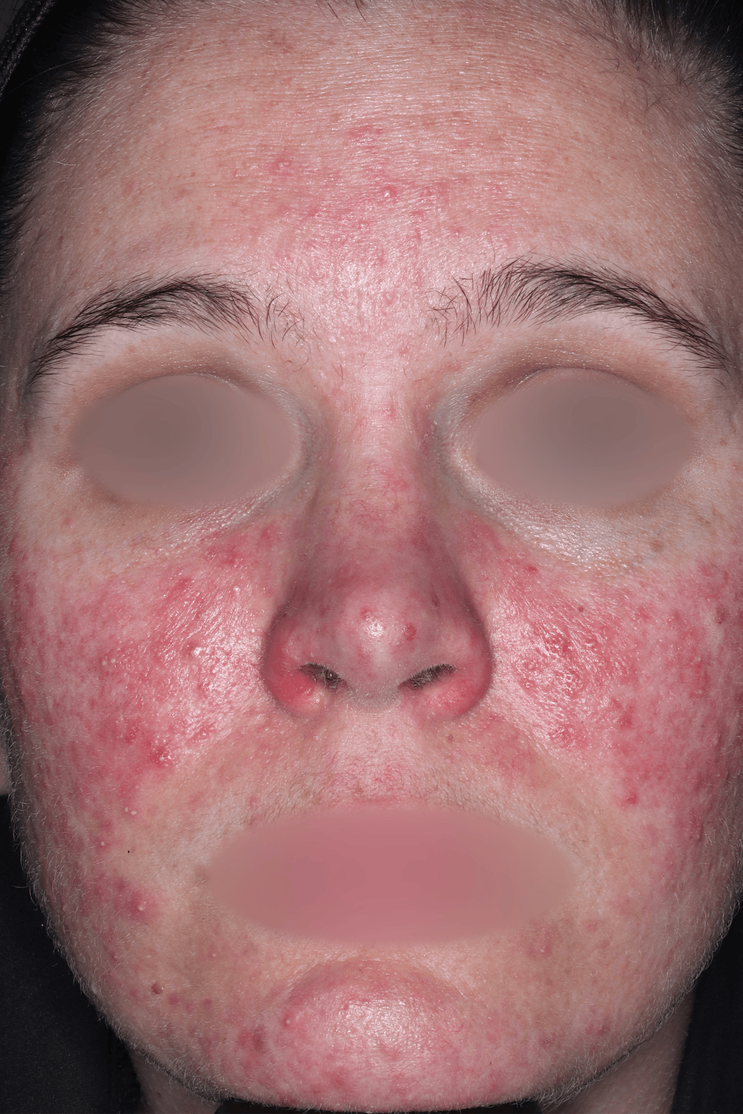 Patient B Before