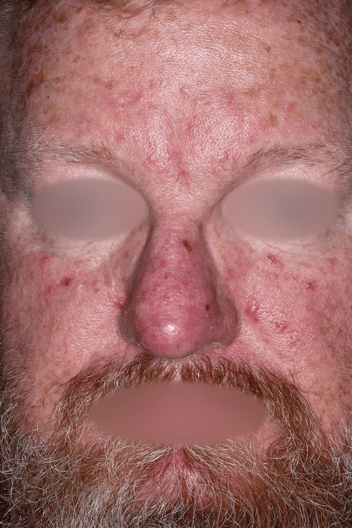 Patient D Before